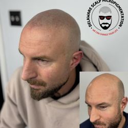 Delaware Scalp Micropigmentation - Realistic SMP solutions for men and women. Located in Wilmington, Delaware - Delaware Scalp Micropigmentation.