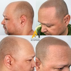 Micropigmentation Academy & Clinic - Scalp Micropigmentation