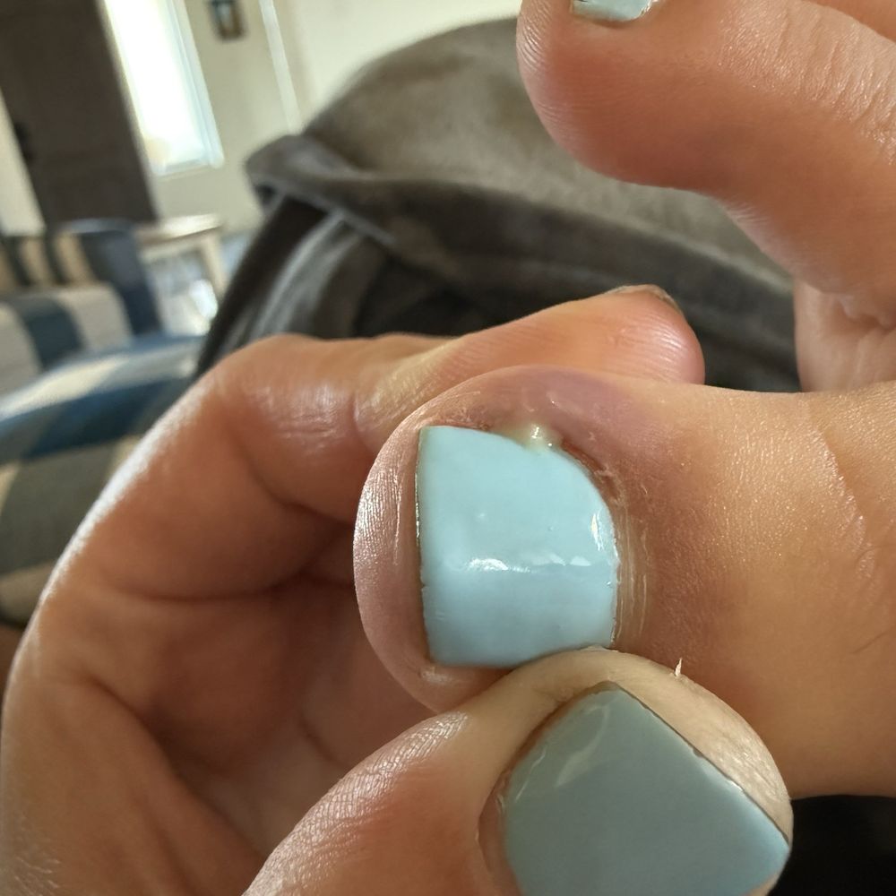 Ucare Nails Bar - Infected toe - Nail Salons Near Me - Escondido, California
