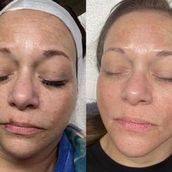 3 sessions of our BioRePeel treatment!