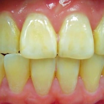 EZ Dental Care - Zoom! Whitening (before) - General Dentistry Near Me - Flushing, New York EZ Dental Care - Zoom! Whitening (before) - General Dentistry Near Me - Flushing, New York