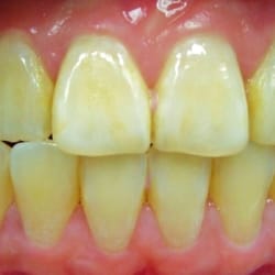 EZ Dental Care - Zoom! Whitening (before)