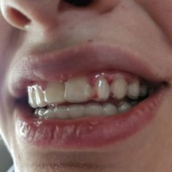 Ridder Orthodontics - Tech got glue all over gums and they had to grind the glue off. Her gums are still bleeding 4 hours after having her braces off.