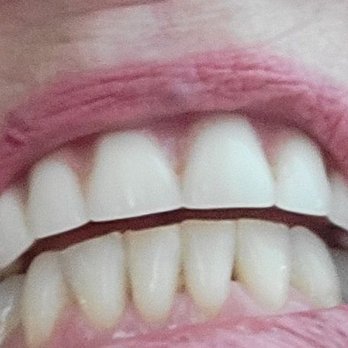 Affordable Dentures & Implants - Bite with dentures - Prosthodontists Near Me - Kearney, Missouri