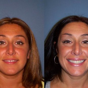 Kellyn Hodges Orthodontics - Before & After from Kellyn Hodges Orthodontics | Montgomeryville, PA - Orthodontists Near Me - Montgomeryville, Pennsylvania Kellyn Hodges Orthodontics - Before & After from Kellyn Hodges Orthodontics | Montgomeryville, PA - Orthodontists Near Me - Montgomeryville, Pennsylvania