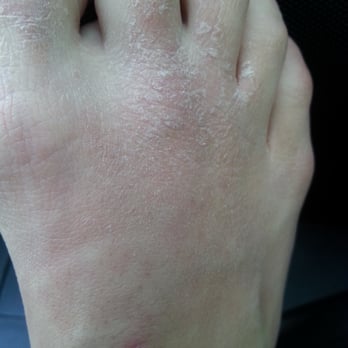 Nails A1 - Rash after pedicure. Dont come here!! Not sanitary at all - Nail Salons Near Me - San Jose, California Nails A1 - Rash after pedicure. Dont come here!! Not sanitary at all - Nail Salons Near Me - San Jose, California