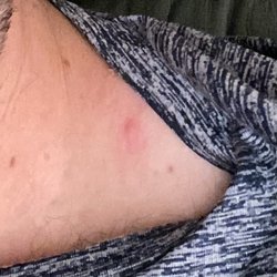 Super 8 by Wyndham JfkAirport/Jamaica - Bug bite on shoulder from laying on the bed.