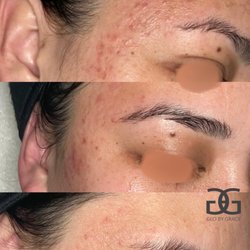 Glo By Grace Skincare Studio - Acne Treatment