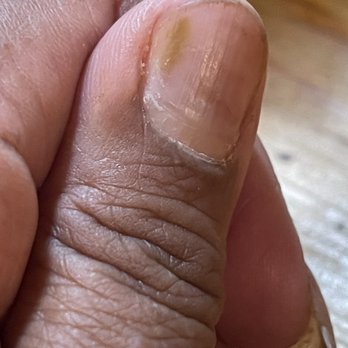 Summit Nail Bar - Infected nails - Nail Salons Near Me - Los Angeles, California