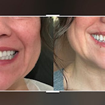 Vanity Beauty Boutique - Teeth whitening before and after - Teeth Whitening Near Me - Las Vegas, Nevada Vanity Beauty Boutique - Teeth whitening before and after - Teeth Whitening Near Me - Las Vegas, Nevada