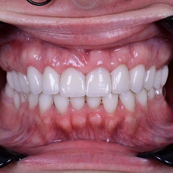 Semyon Segal, DDS - Veneers - General Dentistry Near Me - Los Angeles, California Semyon Segal, DDS - Veneers - General Dentistry Near Me - Los Angeles, California