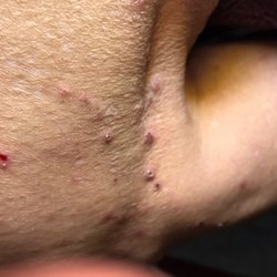 Pelican Family Medicine At Monkey - Photograph of upper thigh with a thicken skin and scabies bites and brews, showing a very old infestation.
