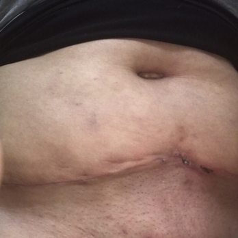 VIDA - Tummy Tuck by Dr Quiroz - Body Contouring Near Me - Tijuana, BCN