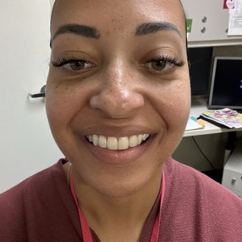 Glow DermSolutions - Clear skin - this is about a week post visit - Medical Spas Near Me - San Jose, California