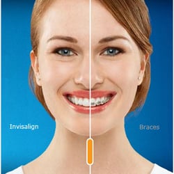 Solar Dental - Payment plans available for Invisalign braces
