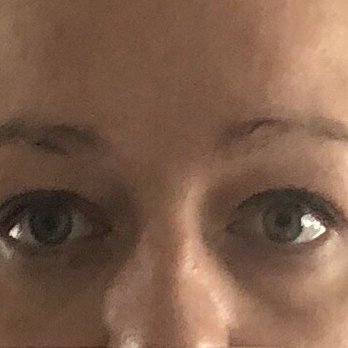 MediZen Aesthetics - After - Laser Hair Removal Near Me - Sutton Coldfield, XWM