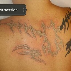 Brooklyn Laser Tattoo Removal - Alex L: half way through session 1