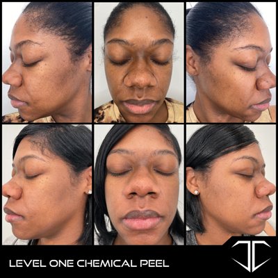 Transformative Results at Charette Cosmetics - Before/After Photos - At Charette Cosmetics, we strive for transformative results! Here is a portfolio of the 1,000's of faces that we have worked on. We offer a wide variety of treatments that we customize to work with your skin. It's time for you to get the beautiful skin, book with us today to start your journey!