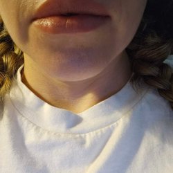 Celebrate Dental & Braces - He shifted my jaw and moved my lip line