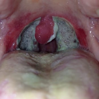 Sikand Ashley, MD - 3 days post tonsillectomy/ Adenoidectomy by Dr Sikhand. - Ear Nose & Throat Near Me - Las Vegas, Nevada Sikand Ashley, MD - 3 days post tonsillectomy/ Adenoidectomy by Dr Sikhand. - Ear Nose & Throat Near Me - Las Vegas, Nevada