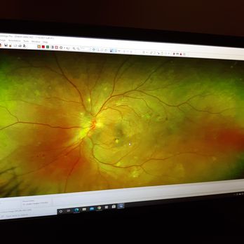 Eye to Eye Vision - Blood in my eyes and hemorrhaging. - Optometrists Near Me - San Antonio, Texas Eye to Eye Vision - Blood in my eyes and hemorrhaging. - Optometrists Near Me - San Antonio, Texas