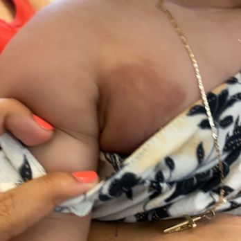 Prince Resort - Bed bug bite on 6month old - Hotels Near Me - North Myrtle Beach, South Carolina