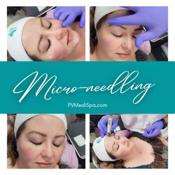 PV MediSpa - Micro-needling using the DermaFrac-C system