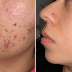 SKInstitute - Acne transformation through personalized treatments and home care.