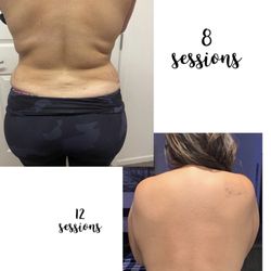 Mi Bella Cavitation - Love my results