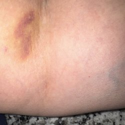 Labcorp - Bruise after the blood draw