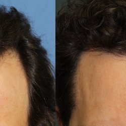 Beverly Hills Hair Restoration - FUT Procedure