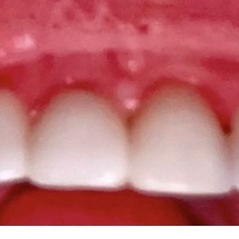 Orthodontics of Oxnard - All 10 veneers. Different shades, lengths and sizes. I hate them. - Orthodontists Near Me - Oxnard, California Orthodontics of Oxnard - All 10 veneers. Different shades, lengths and sizes. I hate them. - Orthodontists Near Me - Oxnard, California
