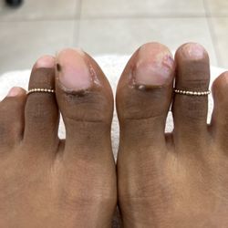 Fantasy Nail Salon - Internal bleeding on both big toes from Kim digging and overly filling