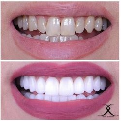 Calabasas Smiles - Smile Makeover