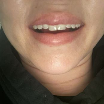 LaserAway - Laser Hair Removal Near Me - Beverly Hills, California