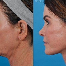 Ponsky Facial Plastic Surgery - Facelift & Upper Lip Lift Before and After Patient Photo