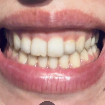 Nahal Ashouri, DDS MS - After - Orthodontists Near Me - Mountain View, California