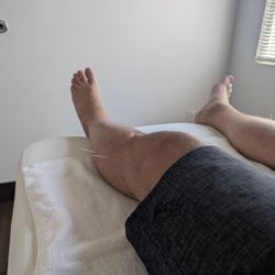 Sunrise Acupuncture Clinic - Needles throughout my legs. Needles in my belly, neck, and wrist as well. Never painful, and Master Lii is terrific at relieving tension
