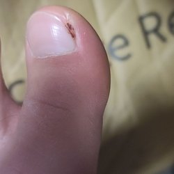 Benedict Ching, DPM - My ingrown toenail that I tried to take out myself