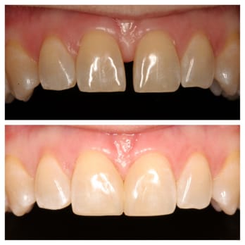 Rush Family Dentistry - Diastema closure with composite material - Cosmetic Dentists Near Me - Mount Washington, Kentucky Rush Family Dentistry - Diastema closure with composite material - Cosmetic Dentists Near Me - Mount Washington, Kentucky