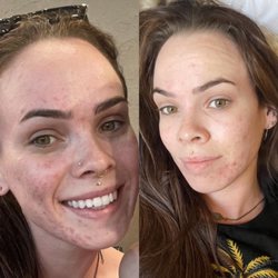 Skin Alchemy - Results after just one acne facial treatment