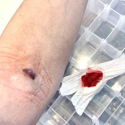Quest Diagnostics - Arm and gauze.