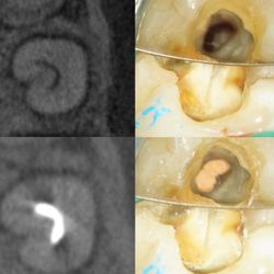 Atlanta Endodontics - All root canals arent perfectly round