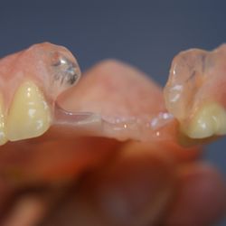 Distinctive Dentures - Clear clasps offered here.