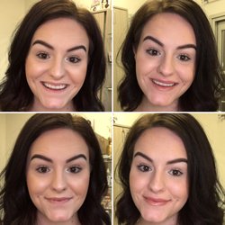 Tulane Department of Dermatology - Before & 2 hours after having lip injections done.