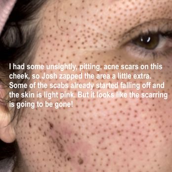 Heavenly Aesthetics - 1 had some unsightly, pitting, acne scars on this cheek, so Josh zapped the area a little extra. - Aestheticians Near Me - San Diego, California Heavenly Aesthetics - 1 had some unsightly, pitting, acne scars on this cheek, so Josh zapped the area a little extra. - Aestheticians Near Me - San Diego, California