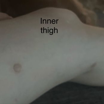 AirSculpt - Beverly Hills - Embarrassing BURN SCAR on my inner thigh - Cosmetic Surgeons Near Me - Beverly Hills, California