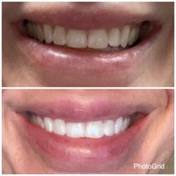 Floss 32 - Top- before Bottom - immediately after