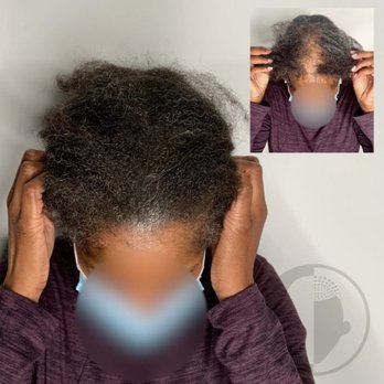 Scalpworx - Hair Loss Centers Near Me - Atlanta, Georgia