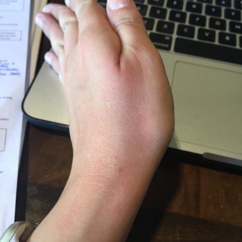 Starbucks - Burned hand because of uncapped hot coffee - Coffee & Tea Near Me - Irvine, California